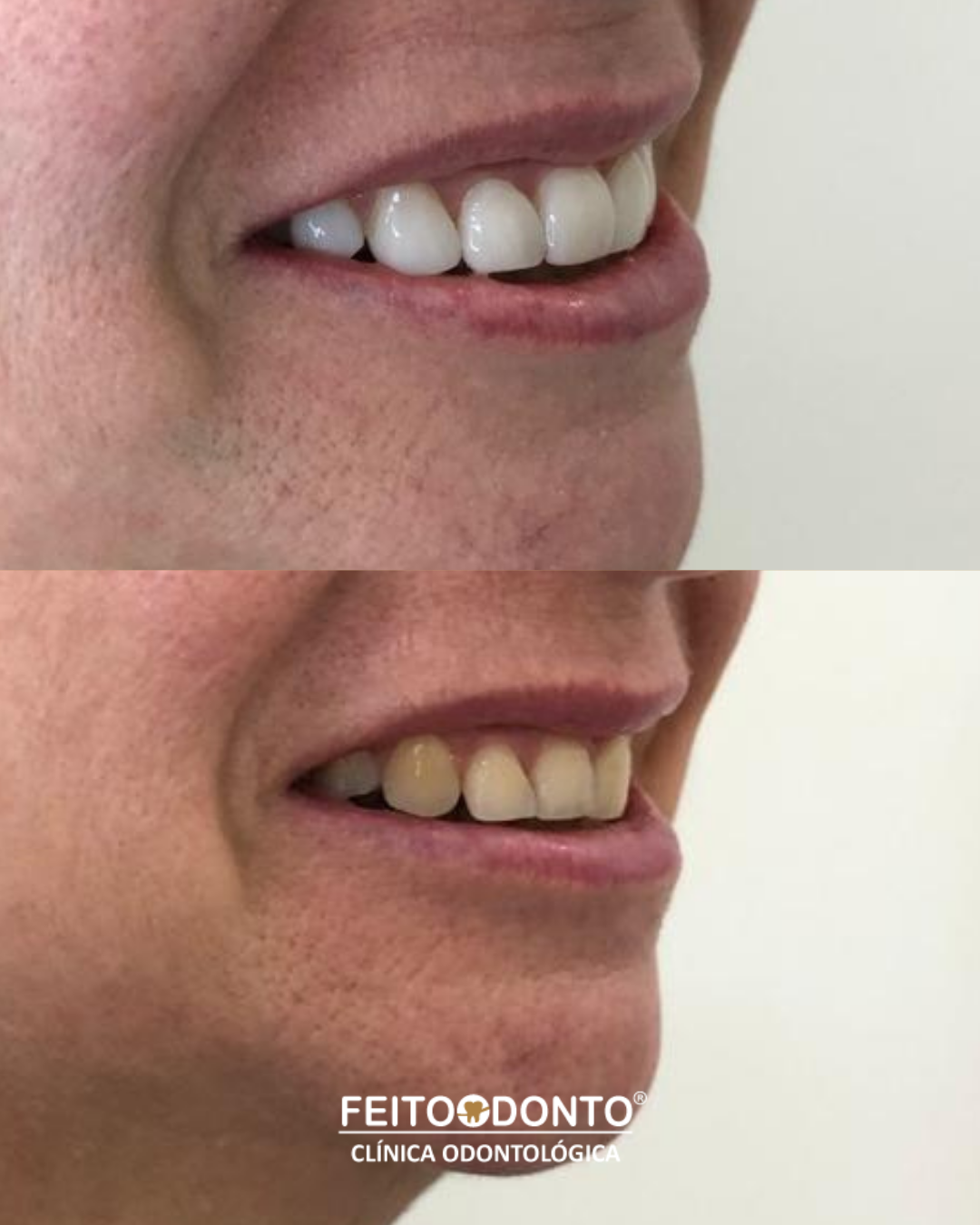 Facetas em resina e um sorriso natural!